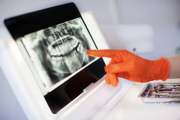 Implantes dentários: Conheça10 benefícios 