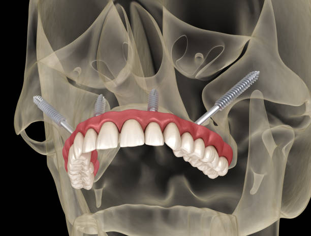Especialista em Implante Dentário.