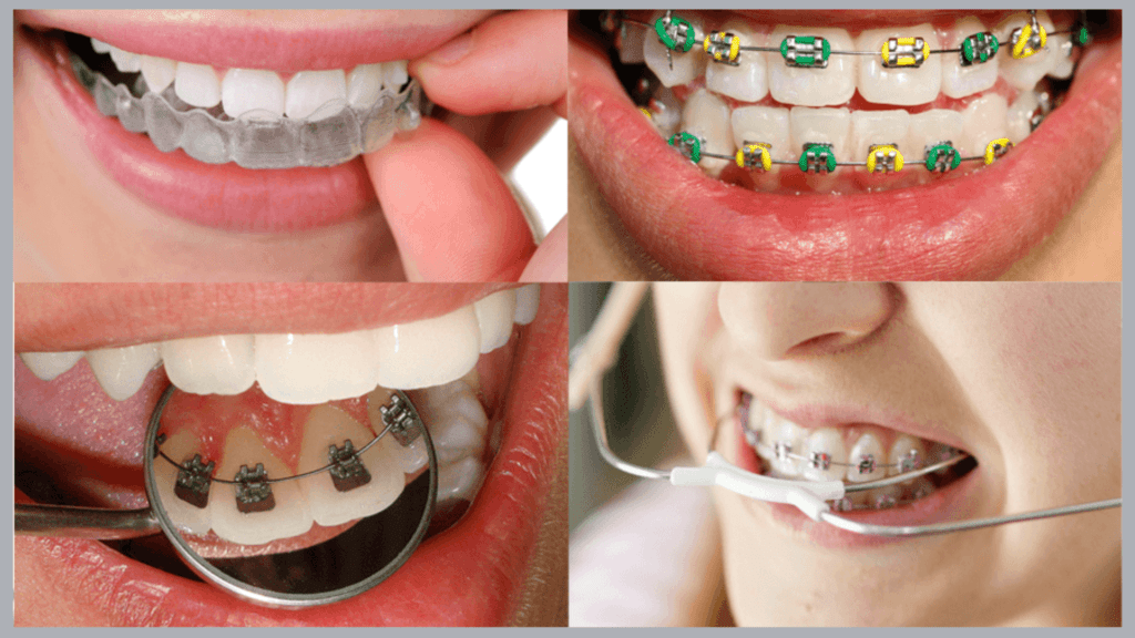 Aparelho Ortodôntico:10 Dicas