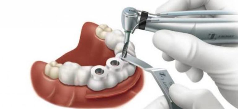 Descubra o Implante Dentário Sem Corte