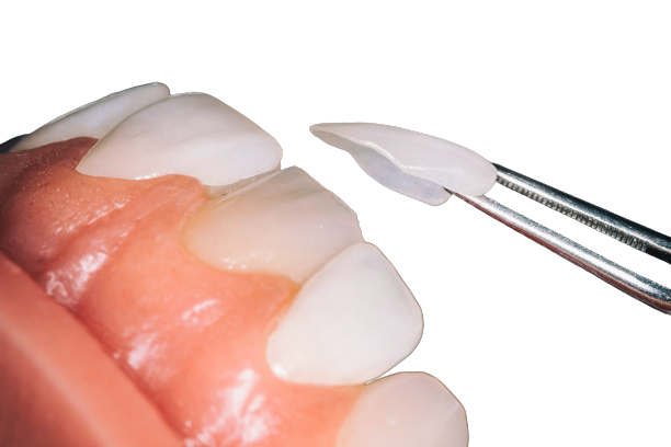 As facetas dentárias têm se tornado uma solução popular para quem deseja melhorar a estética do sorriso.